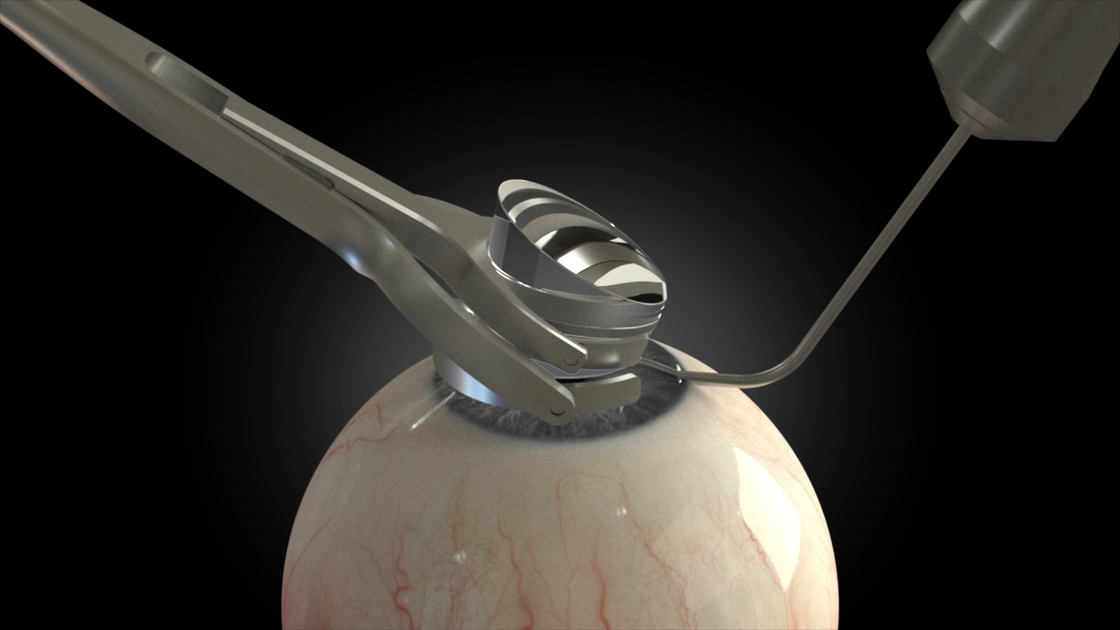 Graphic Visualisation of the iridocorneal angle