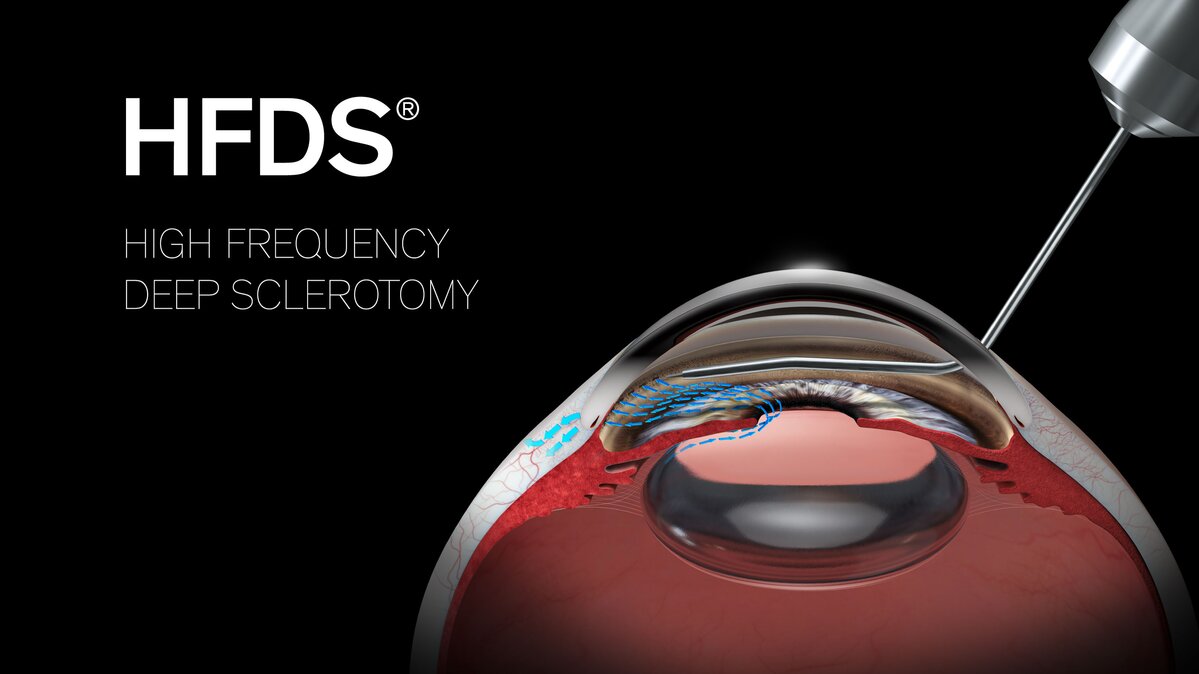 Visualisierung High Frequency Deep Sclerotomy (HFDS)