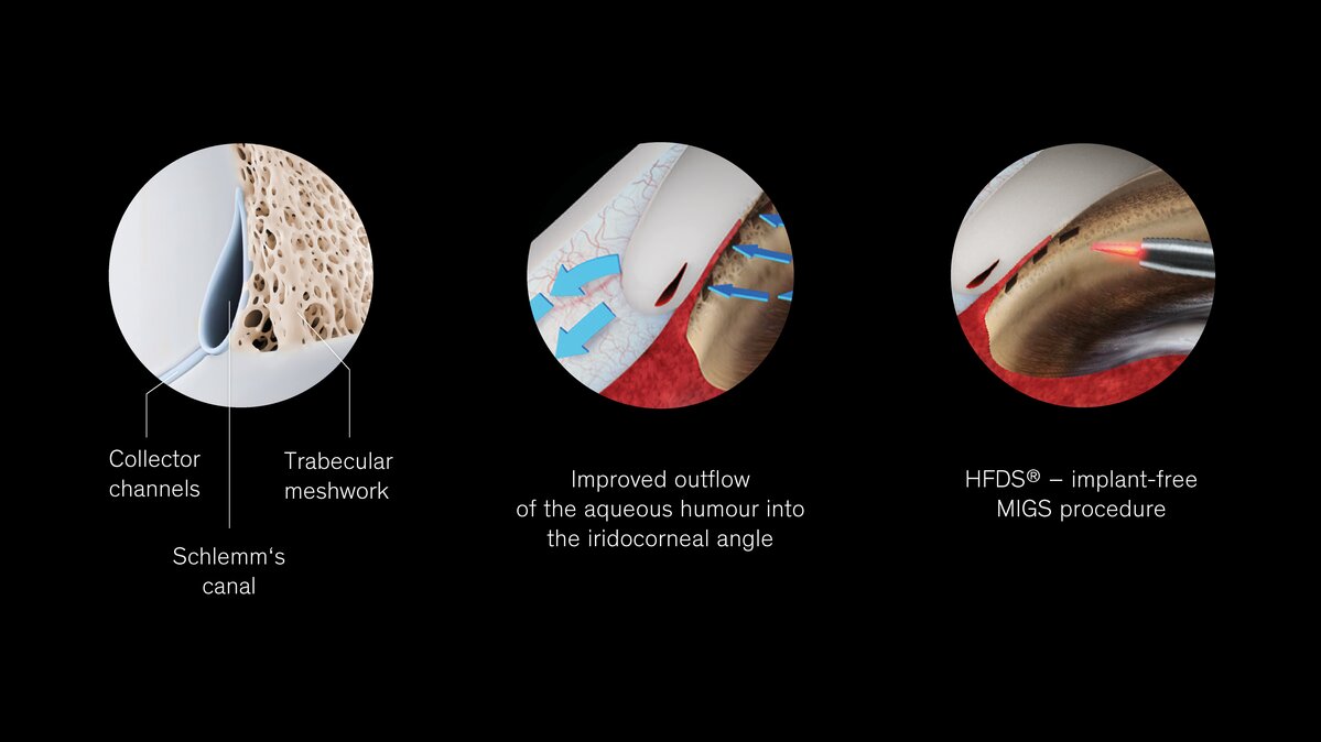 Graphic Overview High Frequency Deep Sclerotomy (HFDS)