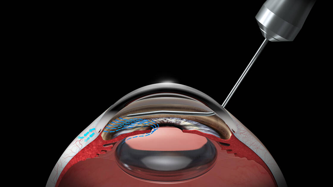 Animation of the use of HFDS during eye surgery