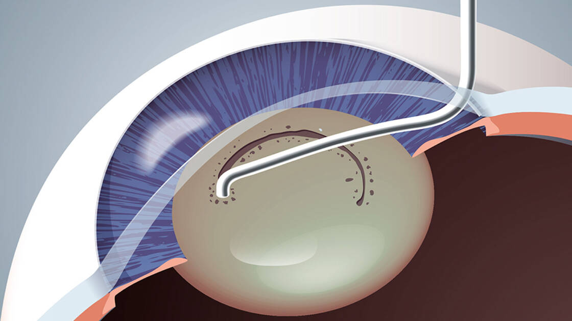 Animation of a capsulotomy in a cataract surgery